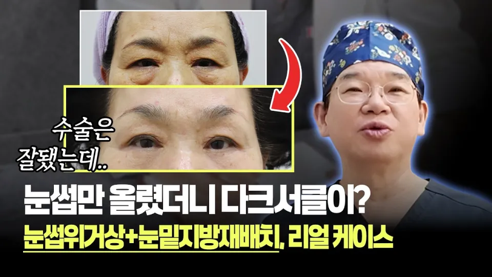눈썹위거상 수술 후 변화와 1년 경과 후기